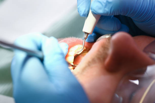Best Emergency Tooth Extraction in Castle Point, MO